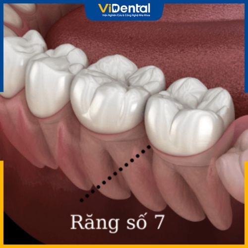 Răng hàm số 7 giữ vai trò quan trọng trong khuôn miệng