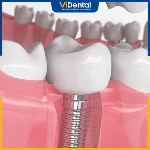 Cấy ghép Implant giúp trồng răng số 7 vững chắc, chống tiêu xương