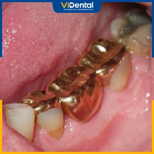 Trồng răng vàng cũng là phương pháp phục hình răng đã mất
