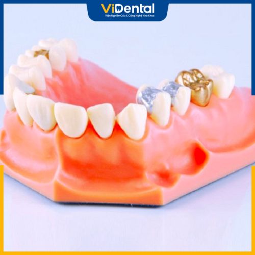 Trồng răng vàng có tồn tại một số nhược điểm