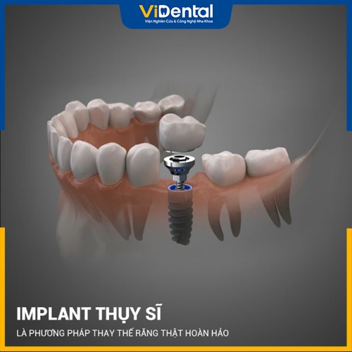 Trụ Implant Thụy Sĩ được đánh giá cao về hiệu quả và chất lượng