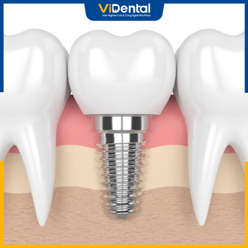 Trồng răng Implant cố định mang đến hiệu quả tốt nhất