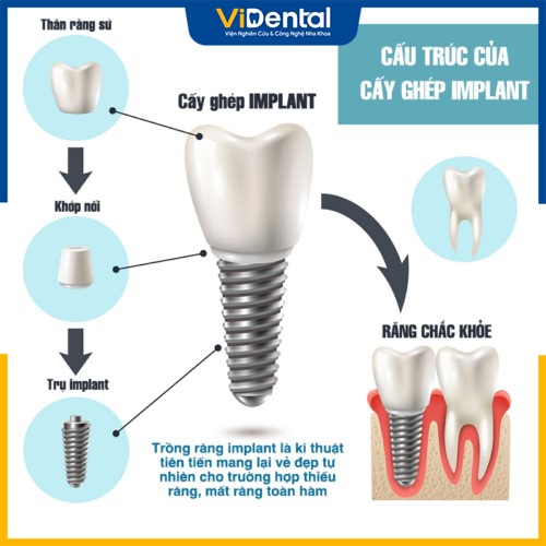 Trồng răng của Implant là phương pháp phổ biến hiện nay