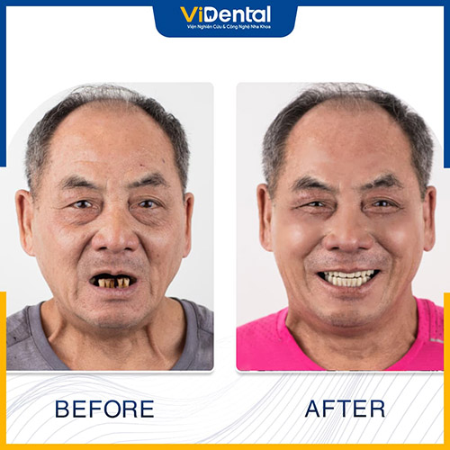 Hình ảnh trước - sau khi trồng răng cửa tại Trung Tâm ViDental Implant