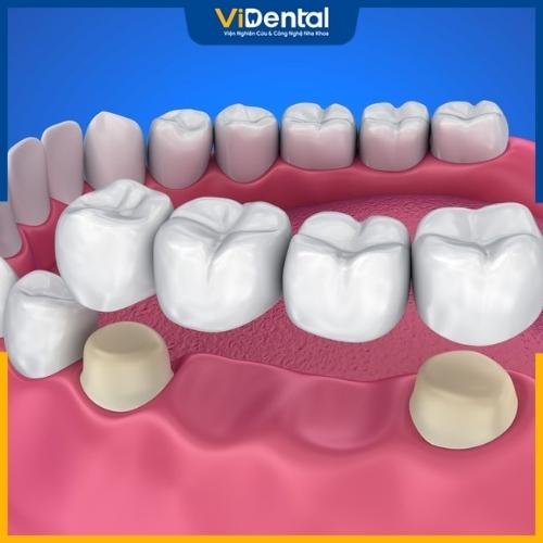 Phương pháp cầu răng sứ giúp khắc phục tình trạng mất răng cấm