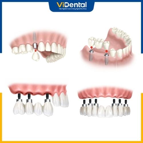 Kỹ thuật Implant là phương pháp trồng răng cấm hiệu quả nhất hiện nay