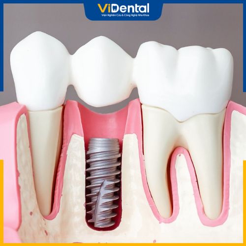 Cấy ghép implant là phương pháp giúp khôi phục răng mất hiệu quả