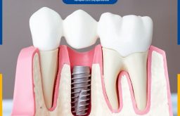 Cắm Răng Implant Bị Sưng Do Đâu Và Làm Sao Khắc Phục?
