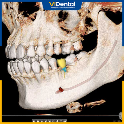 Chụp CT giúp xác định khách hàng đủ điều kiện để trồng răng implant