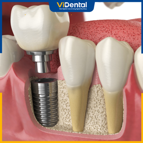 Trồng răng cấy ghép Implant có thể ngăn tiêu xương hàm