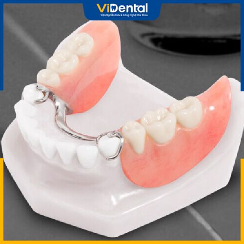 Răng tháo lắp composite là phương pháp phục hình răng được nhiều bệnh nhân lựa chon