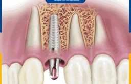 Răng Implant Bị Đào Thải: Dấu Hiệu Cảnh Báo, Hướng Khắc Phục