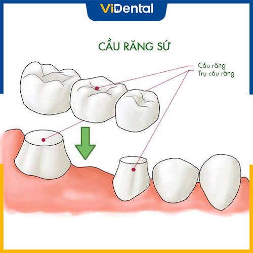 Tuổi thọ của cầu răng sứ phụ thuộc nhiều yếu tố