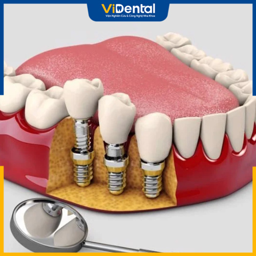 Cấy ghép Implant có thể phục hình độc lập từng răng