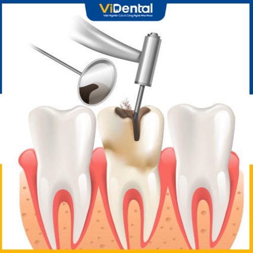 Lấy tủy trước khi trồng răng không đau đớn, nguy hiểm khi đúng kỹ thuật