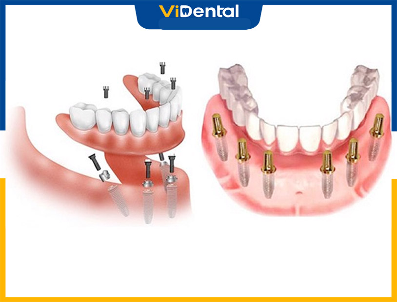 Cấy ghép implant chất lượng cao