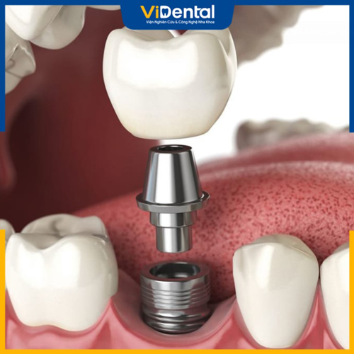 Cấy ghép và phục hình răng Implant được nhiều người lựa chọn