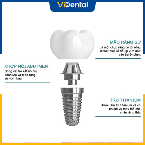 Lựa chọn loại răng Implant phù hợp để tiết kiệm chi phí