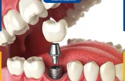 Trồng Răng Implant: Đối Tượng, Quy Trình Thực Hiện Và Chi Phí