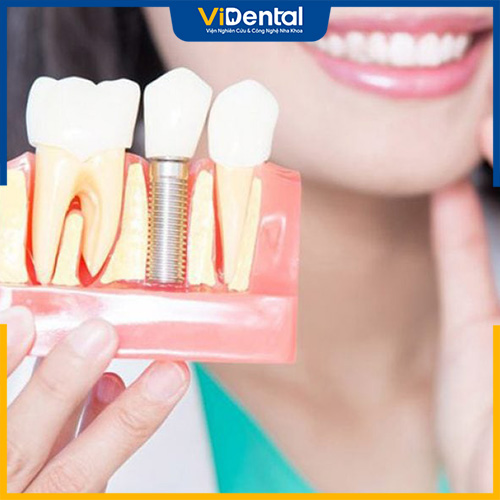 Răng implant sau khi cắm cần được chăm sóc cẩn thận