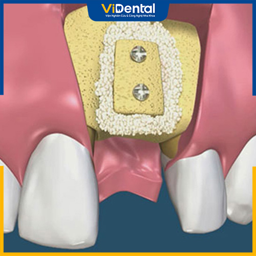 Tuỳ theo trường hợp cụ thể mà bác sĩ sẽ tư vấn loại màng xương phù hợp