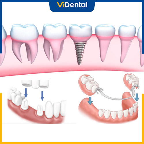Các phương pháp phục hình khi mất 2 răng hàm