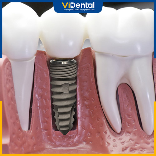 Răng implant bị lung lay có thể do nhiều nguyên nhân khác nhau