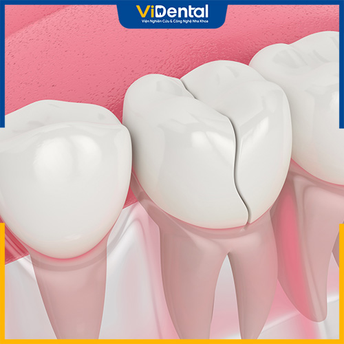 Răng sứ bị sứt mẻ, kênh hoặc gặp vấn đề thì nên thay mới