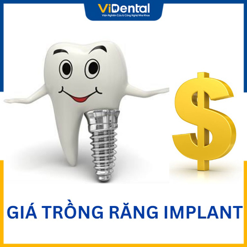 Nhiều người e ngại trước mức phí trồng răng Implant