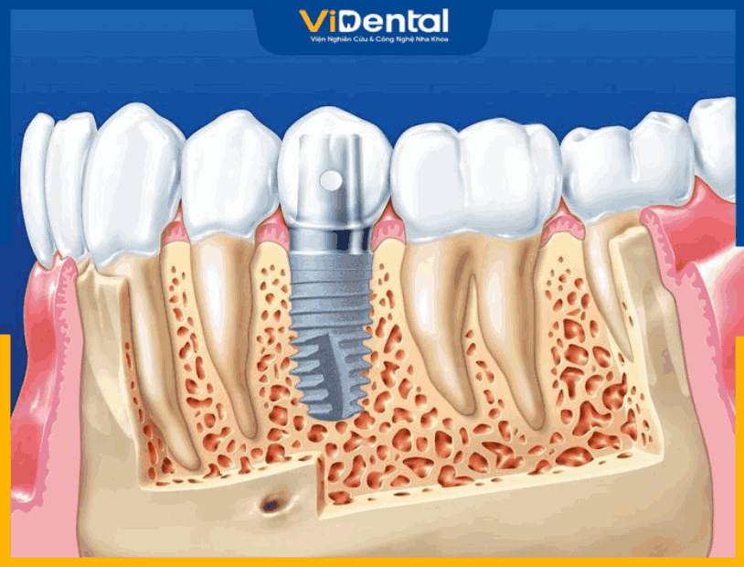 Cấy ghép implant tại TP.HCM