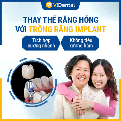 ViDental là địa chỉ trồng răng được nhiều khách hàng tin chọn 