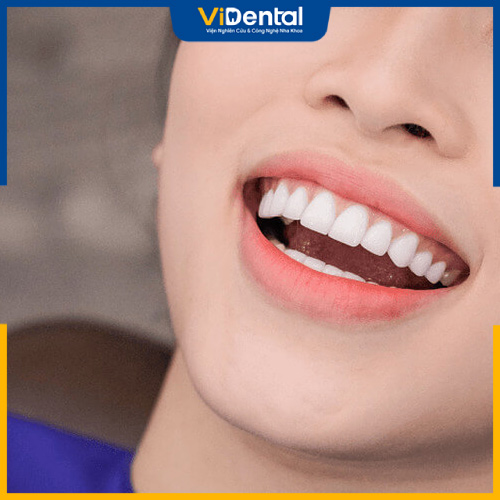 Dòng trụ này có khả năng cải thiện tính thẩm mỹ cho hàm răng