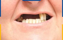 Mất Nhiều Răng: Nguyên Nhân, Hậu Quả Và Cách Xử Lý