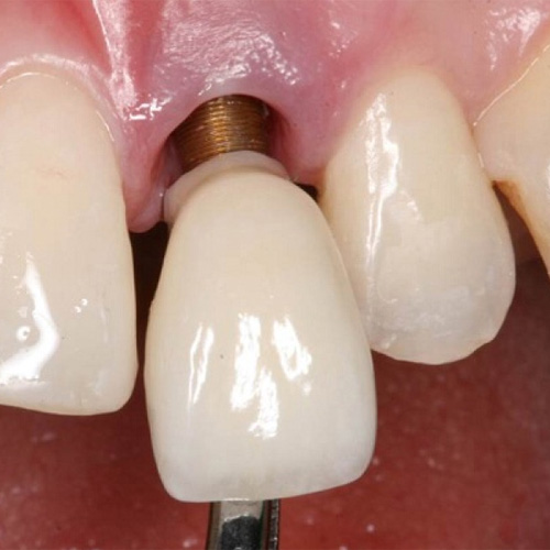 Răng Implant bị lung lay do nhiều nguyên nhân