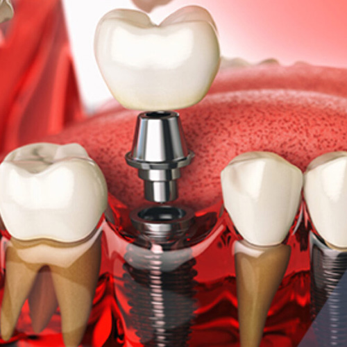 Răng Implant bị lung lay có thể phải thay răng mới