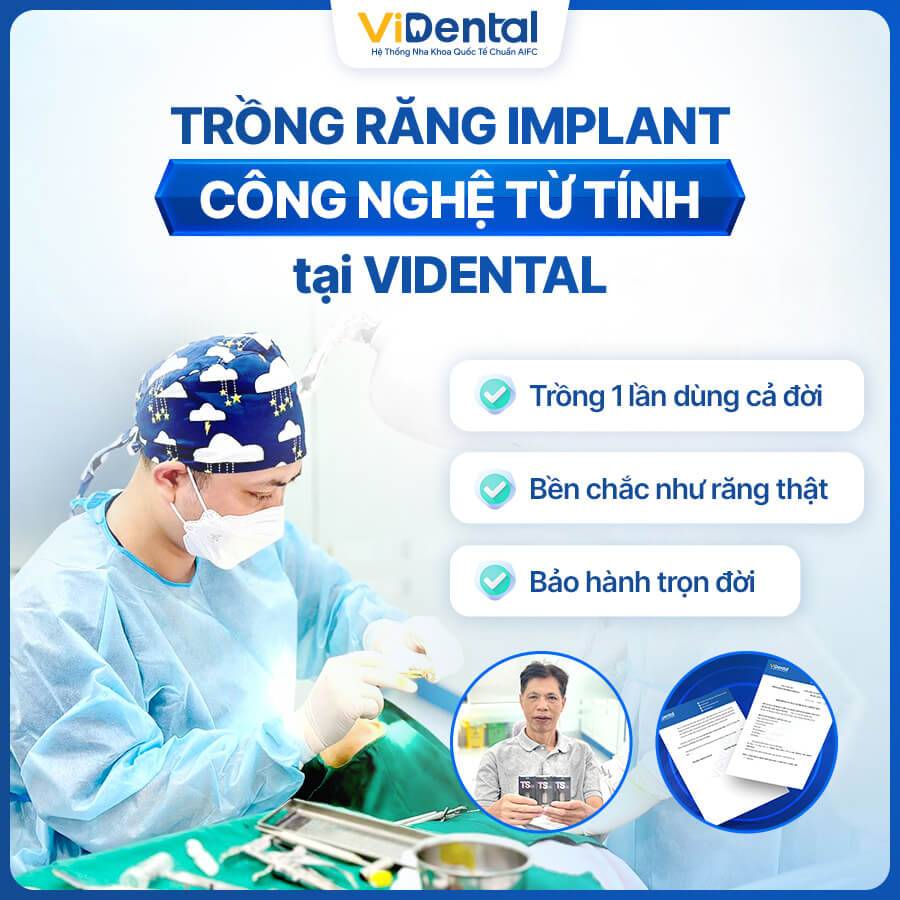 Trụ Implant hiện đại