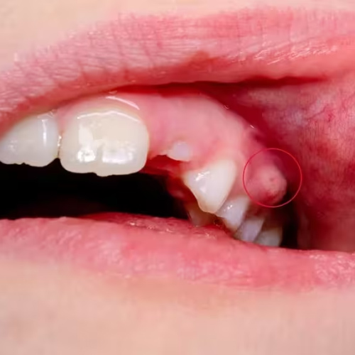 Áp xe răng xảy ra do sâu răng