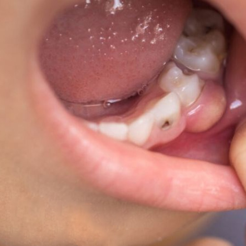 Áp xe nha chu xảy ra trong mô nha chu xung quanh răng