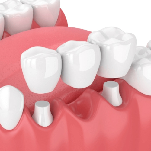 Cầu răng sứ sẽ khó tránh khỏi tình trạng tiêu xương