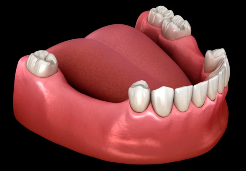 Chăm sóc răng miệng không đúng cách gây mất răng