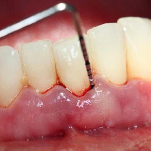 Tình trạng mất răng toàn hàm do các bệnh lý răng miệng