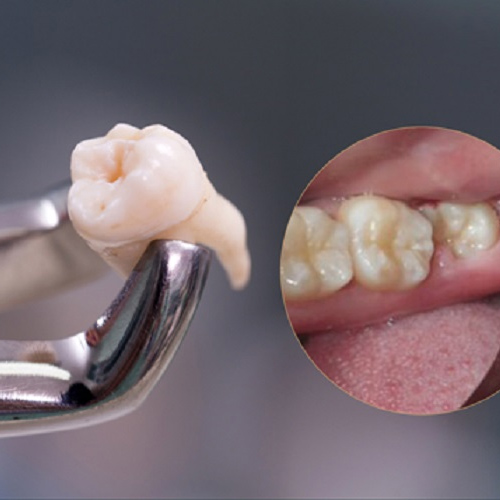 Giá nhổ răng khôn phụ thuộc vào số lượng răng cần nhổ