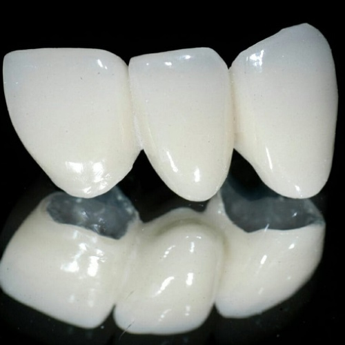 Răng sứ Titan Vita sở hữu nhiều ưu điểm vượt trội