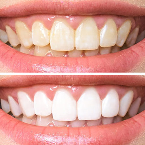 Tẩy trắng răng giúp hàm răng trắng sáng, đều màu