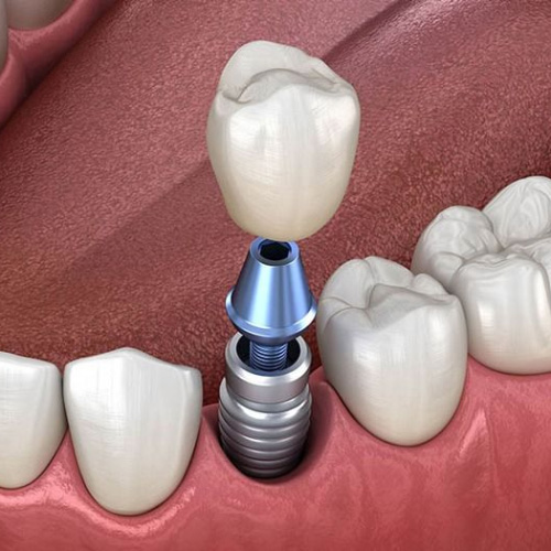 Thời gian trồng răng sứ ảnh hưởng bởi tình trạng răng miệng 