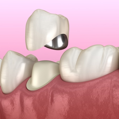 Bọc răng sứ sử dụng mão sứ để gắn ra ngoài răng thật