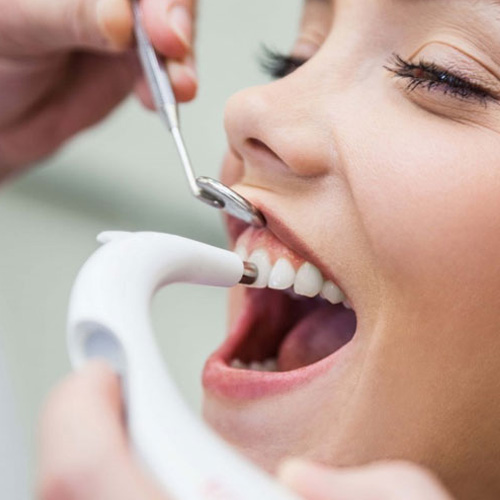 Quá trình bọc răng sứ thường gồm 4 bước