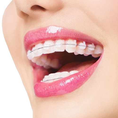 Niềng răng là một phương pháp được rất nhiều khách hàng lựa chọn