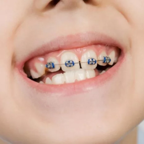 Thời điểm tốt nhất để niềng răng là từ 10 đến 16 tuổi
