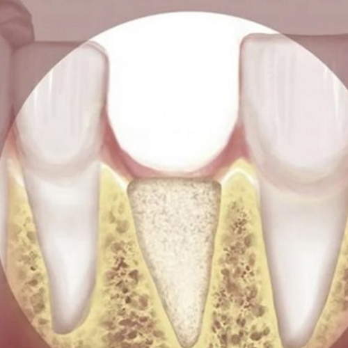 Mất răng dẫn tới tình trạng tiêu xương ổ răng